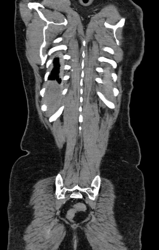 Acute pancreatitis (Radiopaedia 80007-93285 Coronal C+ portal venous phase 136).jpg