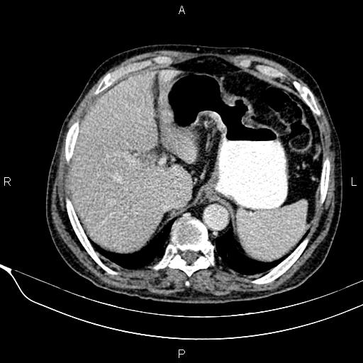 File:Acute pancreatitis (Radiopaedia 85146-100701 Axial C+ portal venous phase 17).jpg