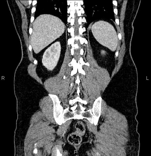 Acute pancreatitis (Radiopaedia 85390-101010 Coronal C+ portal venous phase 59).jpg