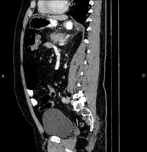 Acute pancreatitis (Radiopaedia 85390-101010 Sagittal C+ portal venous phase 62).jpg
