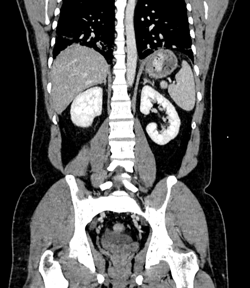 Acute pancreatitis (Radiopaedia 87428-103757 Coronal C+ portal venous phase 64).jpg