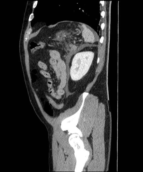 Acute pancreatitis - Balthazar E (Radiopaedia 23080-23110 Sagittal C+ portal venous phase 81).jpg