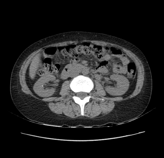 File:Acute pancreatitis - Balthazar E - post ERCP (Radiopaedia 27562-27772 Axial non-contrast 30).png