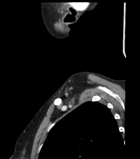 File:Acute parotitis (Radiopaedia 27425-27619 Sagittal C+ portal venous phase 53).png