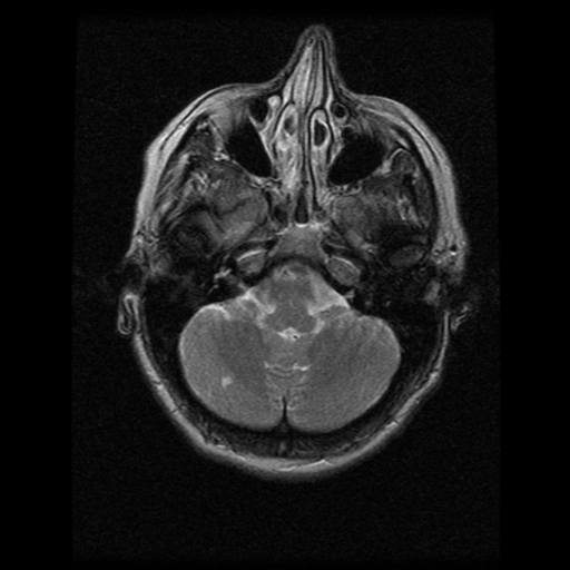 File:Acute pontine infarct from vertebral artery dissection (Radiopaedia 34111-35370 Axial T2 4).png