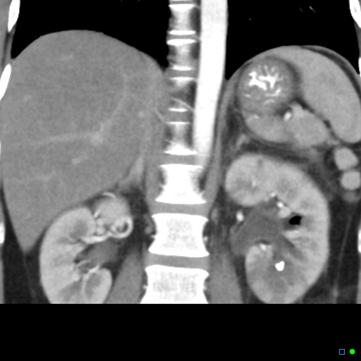 File:Acute pyelonephritis and emphysematous pyonephrosis (Radiopaedia 27893-28128 Coronal renal cortical phase 9).jpg