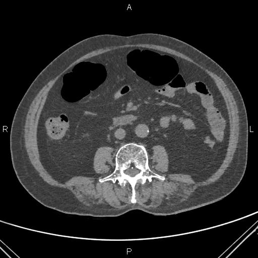 File:Acute renal artery occlusion (Radiopaedia 86586-102682 Axial non-contrast 43).jpg