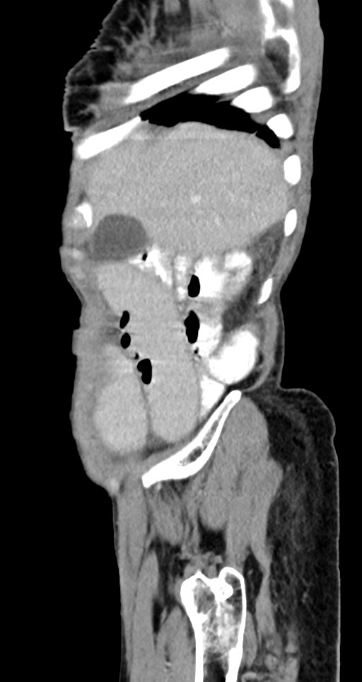Acute small bowel (ileal) volvulus (Radiopaedia 71740-82139 Sagittal C+ portal venous phase 138).jpg
