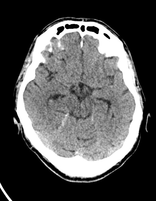 Acute superior cerebellar artery territory infarct (Radiopaedia 84104-99359 Axial non-contrast 43).jpg
