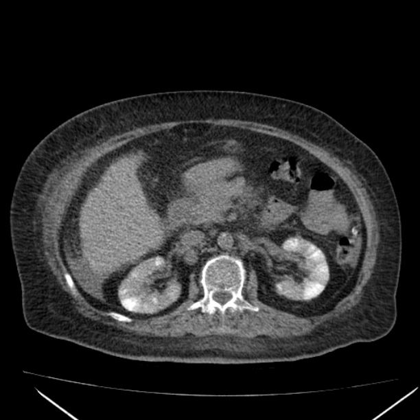 Acute tubular necrosis (Radiopaedia 28077-28334 Axial non-contrast 29).jpg