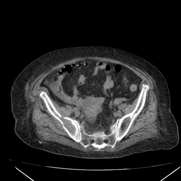 Acute tubular necrosis (Radiopaedia 28077-28334 Axial non-contrast 54).jpg