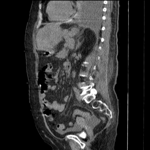 Acute tubular necrosis (Radiopaedia 28077-28334 Sagittal non-contrast 54).jpg