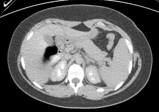 Acute unilateral nonhemorrhagic adrenal infarction (Radiopaedia 67560-76957 Axial renal excretory phase 31).jpg