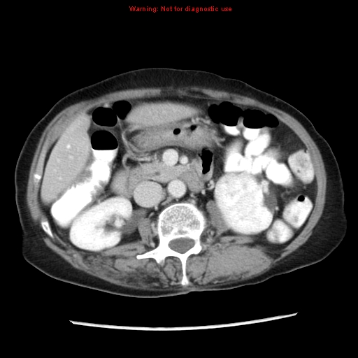 File:Adenocarcinoma of the colon (Radiopaedia 8191-9039 Axial liver window 32).jpg