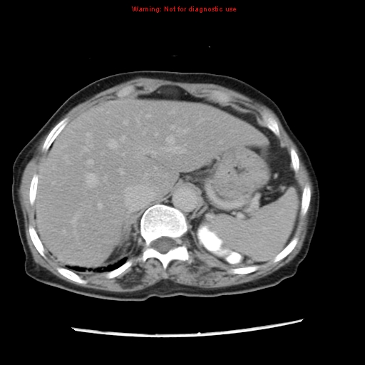 Adenocarcinoma of the colon (Radiopaedia 8191-9039 Axial renal excretory phase 2).jpg