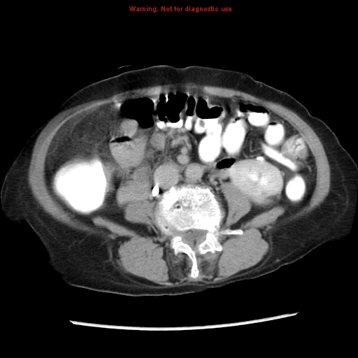 Adenocarcinoma of the colon (Radiopaedia 8191-9039 Axial renal excretory phase 28).jpg