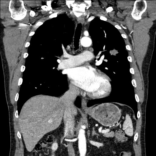 Adenocarcinoma of the lung (Radiopaedia 59871-67325 Coronal C+ arterial phase 35).jpg