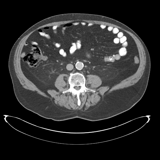 Adenocarcioma of rectum- T1 lesion (Radiopaedia 36921-38547 Axial C+ portal venous phase 49).png