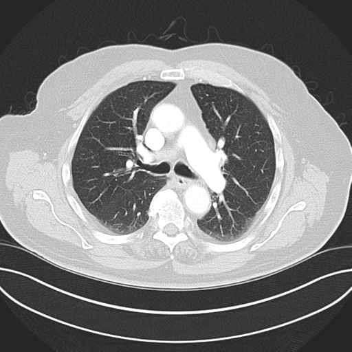 Adenocarcioma of rectum- T1 lesion (Radiopaedia 36921-38547 Axial lung window 24).png