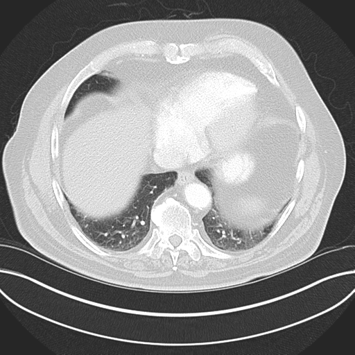 Adenocarcioma of rectum- T1 lesion (Radiopaedia 36921-38547 Axial lung window 42).png
