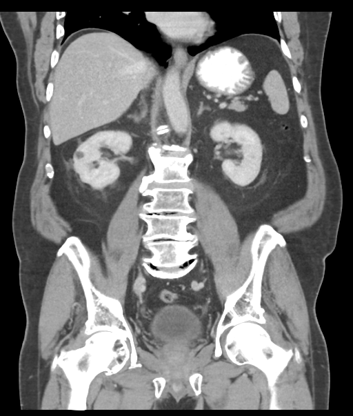 Adenocarcioma of rectum- T1 lesion (Radiopaedia 36921-38547 Coronal C+ portal venous phase 38).png