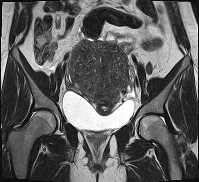 File:Adenomyosis - ovarian endometriomas (Radiopaedia 67031-76350 Coronal T2 13).jpg