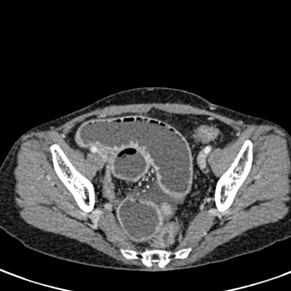 File:Adhesional small bowel obstruction (Radiopaedia 48397-53305 Axial C+ portal venous phase 77).jpg