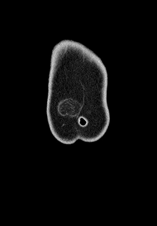 Adhesional small bowel obstruction (Radiopaedia 58900-66131 Coronal C+ portal venous phase 44).jpg