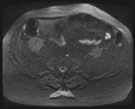 Adrenal cortical carcinoma (Radiopaedia 64017-72770 Axial DWI 123).jpg