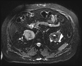 File:Adrenal cortical carcinoma (Radiopaedia 64017-72770 Axial DWI 19).jpg