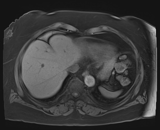 Adrenal cortical carcinoma (Radiopaedia 64017-72770 Axial T1 fat sat 4).jpg