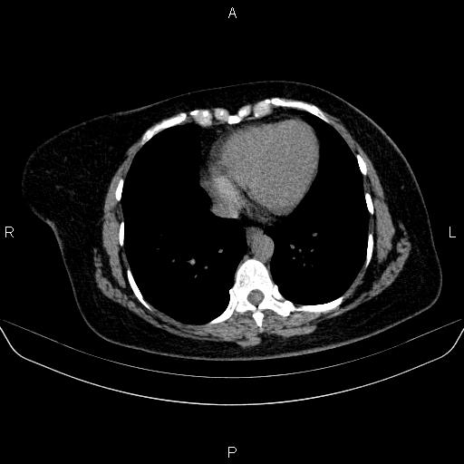 File:Adrenal cortical carcinoma (Radiopaedia 84882-100379 Axial non-contrast 4).jpg