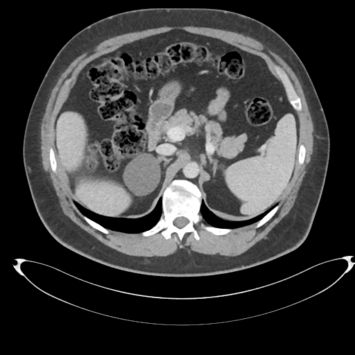 File:Adrenal cyst (Radiopaedia 45625-49778 AXIAL THICK 60 sec 20).png