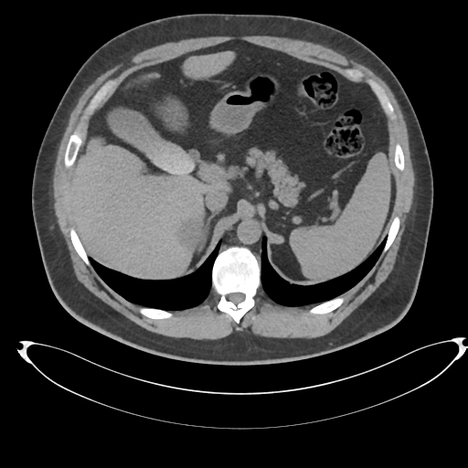 File:Adrenal cyst (Radiopaedia 45625-49778 Axial non-contrast 25).png