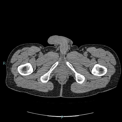 Adrenal cystic lymphangioma (Radiopaedia 83161-97534 Axial non-contrast 108).jpg