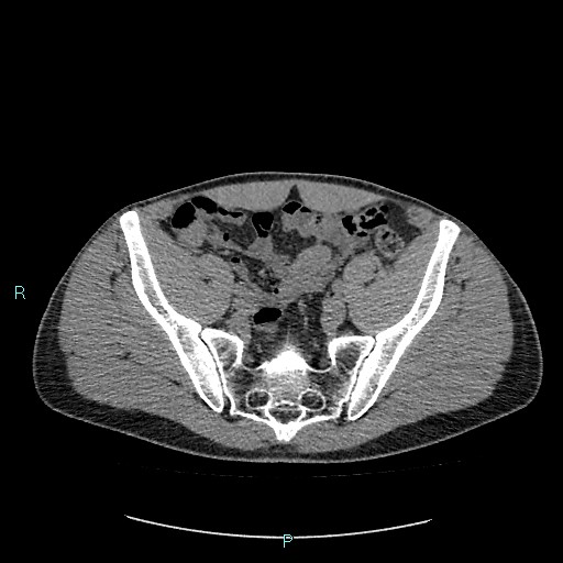 File:Adrenal cystic lymphangioma (Radiopaedia 83161-97534 Axial non-contrast 77).jpg