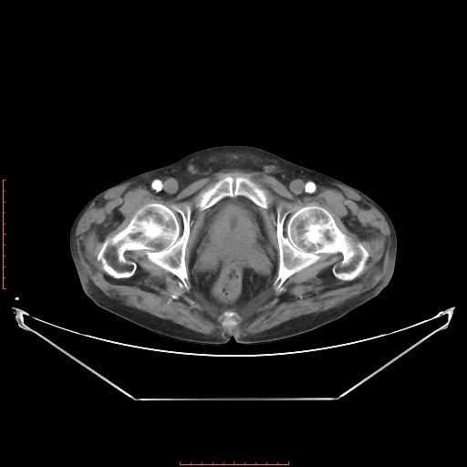 Adrenal hemangioma (Radiopaedia 68923-78668 Axial C+ arterial phase 71).jpg