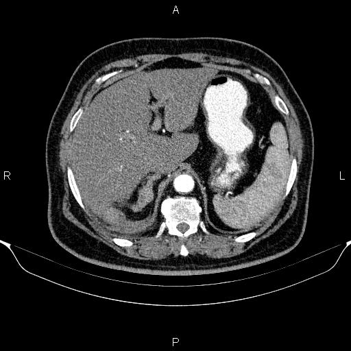 Adrenal hemorrhage (Radiopaedia 62622-70916 Axial C+ arterial phase 75).jpg