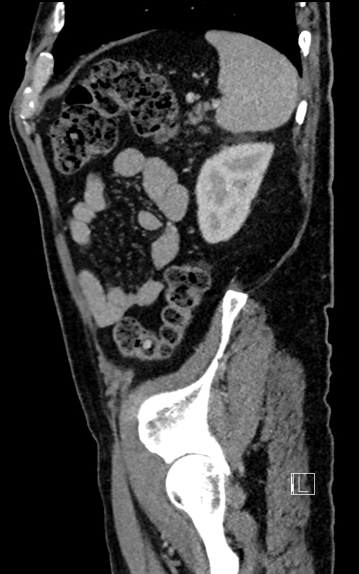 Adrenal lymphoma (Radiopaedia 73730-84529 Sagittal C+ portal venous phase 89).jpg