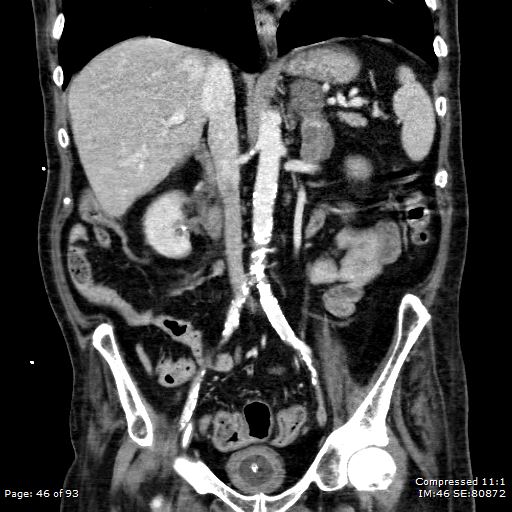 Adrenal metastasis (Radiopaedia 78425-91079 Sagittal C+ portal venous phase 33).jpg