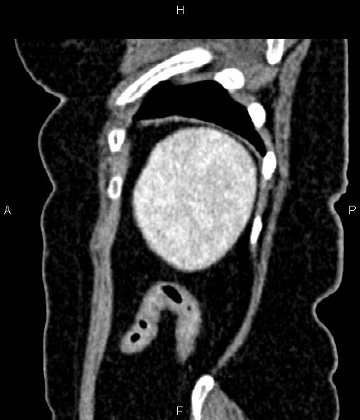 Adrenal myelolipoma (Radiopaedia 82742-96986 Sagittal renal cortical phase 94).jpg