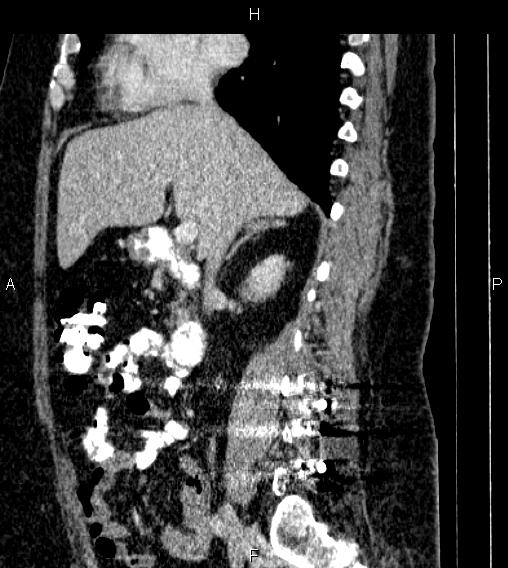 Adrenal myelolipoma (Radiopaedia 84319-99617 Sagittal renal cortical phase 37).jpg