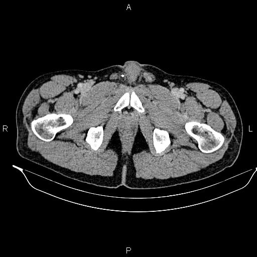 Adrenal myelolipoma (Radiopaedia 87794-104246 Axial renal cortical phase 112).jpg