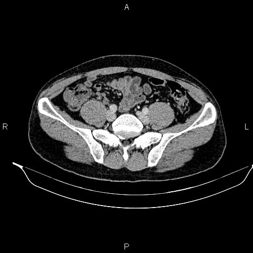 Adrenal myelolipoma (Radiopaedia 87794-104246 Axial renal cortical phase 77).jpg