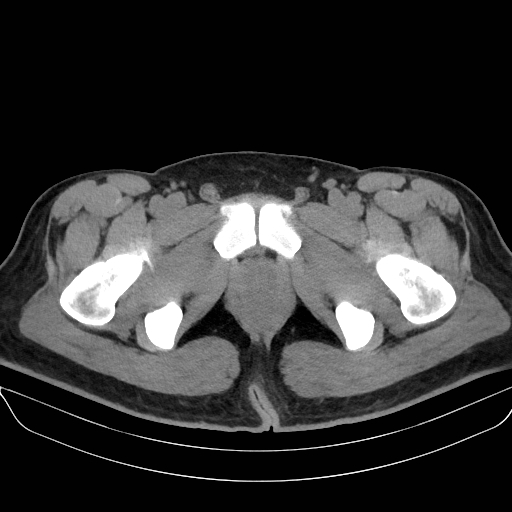 Adrenal myelolipoma - bilateral (Radiopaedia 74805-85810 Axial non-contrast 86).jpg