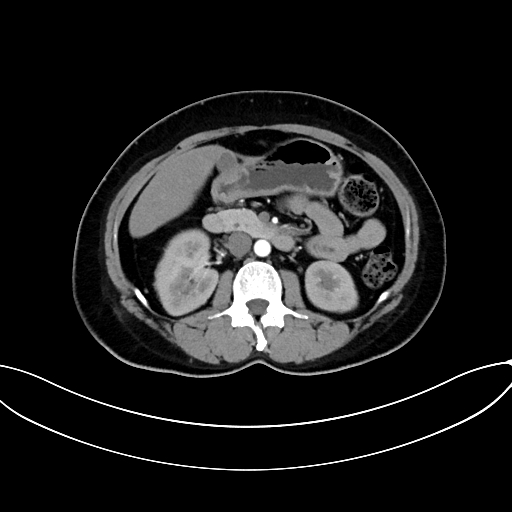 Adrenocortical carcinoma (Radiopaedia 87281-103569 Axial C+ arterial phase 39).jpg
