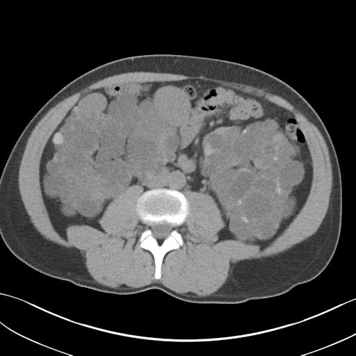 File:Adult polycystic kidney disease (Radiopaedia 47866-52626 Axial non-contrast 43).png