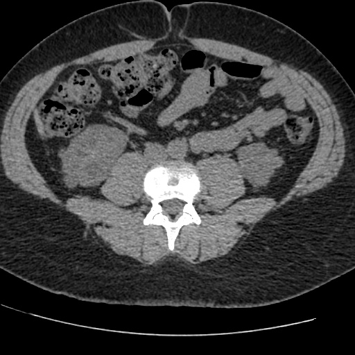 Adult polycystic kidney disease (Radiopaedia 59075-66368 Axial non-contrast 53).jpg