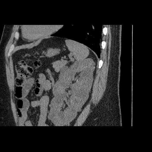 Adult polycystic kidney disease (Radiopaedia 59075-66368 Sagittal non-contrast 68).jpg