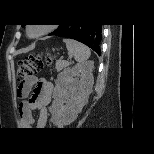 Adult polycystic kidney disease (Radiopaedia 59075-66368 Sagittal non-contrast 71).jpg